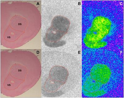 Striatal increase of dopamine receptor 2 density in idiopathic and syndromic mouse models of autism spectrum disorder